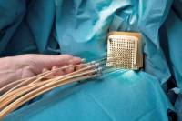 Брахитерапия рака простаты