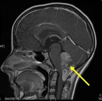 Лечение рака мозга