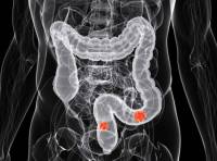 Рак прямой кишки