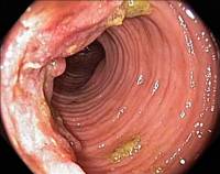 Наследственный рак кишечника