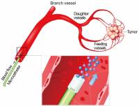 Артериальная химиотерапия (инфузия в печеночную артерию)