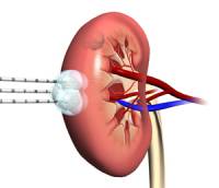 Абляция опухолей почек с визуальным контролем