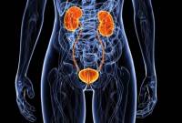 Радикальная нефрэктомия