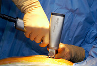 Остеосаркома