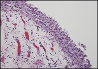Лечение раннего рака мочевого пузыря низкой степени злокачественности