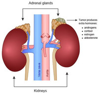 Рак надпочечников