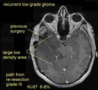 Краниотомия в сознании