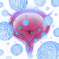 Иммунотерапия рака мочевого пузыря