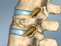Артродез - слияние позвонков