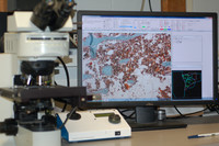 Саркома Юинга