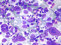 Что нужно знать об иммунотерапии лимфомы?