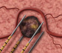 Нано-нож NanoKnife® или электроабляция IRE в Израиле