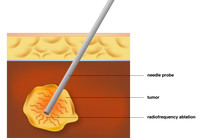 Радиочастотная абляция (RFA) при лечении немелкоклеточного рака легкого